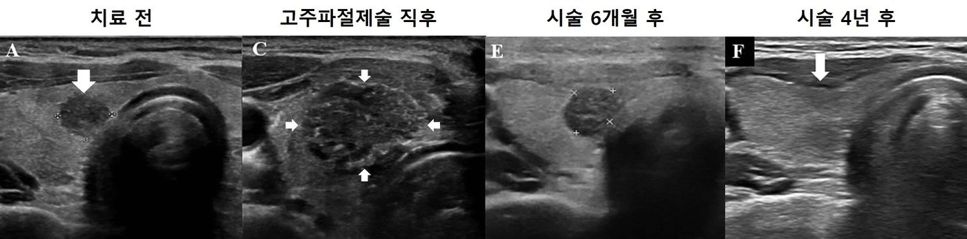 본문 이미지 - 고주파절제술을 이용한 미세갑상선유두암 치료 과정.&#40;서울대병원 제공&#41;