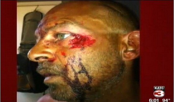 본문 이미지 - 칼 자쿠닉스에게 물려 얼굴이 뜯긴 토드 크레더 (KATC) © News1 