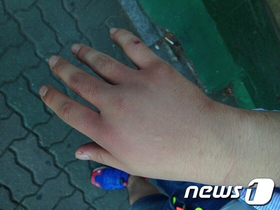 본문 이미지 - 변모씨는 '뒷수갑'을 채운 채 세 시간 동안 경찰 수사를 받아 손이 부었다고 주장했다. 손목에 수갑으로 인해 든 멍이 보인다. © News1 