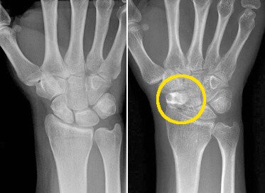 본문 이미지 - 사진 왼쪽은 정상 손목, 오른쪽은 표시된 부분이 주상골로 불유합이 일어나면서 옆의 다른 손목뼈들의 위치가 붕괴된 것© News1  