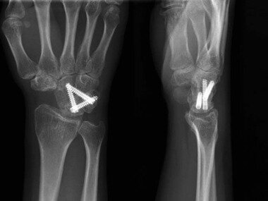 본문 이미지 - 압박 금속나사를 이용한 사중관절 유합술© News1  