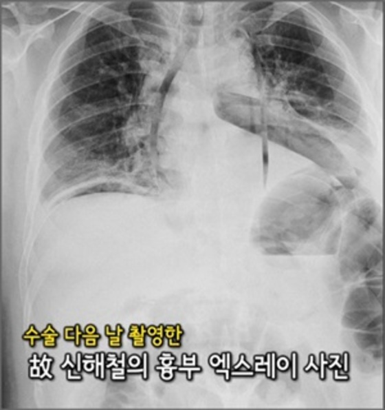 그것이 알고싶다' 故 신해철 엑스레이 사진 공개돼 논란 확산