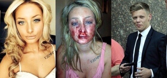 본문 이미지 - 한 여성이 남자친구와 키스하던 중 입술을 물어 뜯겼다. ⓒ News1 스포츠/온라인커뮤니티