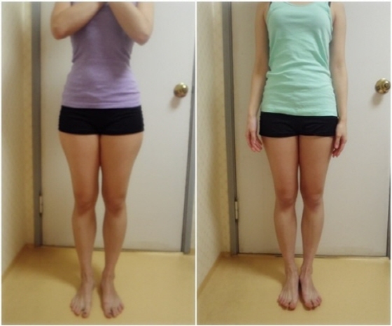 허벅지 지방 분해 주사 | 복부와 팔뚝 허벅지까지 제로팟 다이어트 후기 3