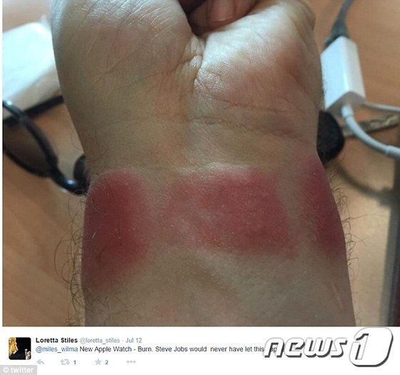 본문 이미지 - 애플워치로 인해 피부 알러지가 생겼다는 사용자의 트윗 ⓒ News1