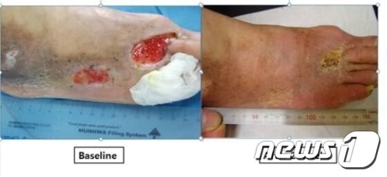 본문 이미지 - 서울성모병원과 보라매병원서 진행한 바스코스템 임상연구에서 환자의 족부 궤양 변화(치료 전과 치료 24주후 비교) /자료 : 알바이오 ⓒ News1