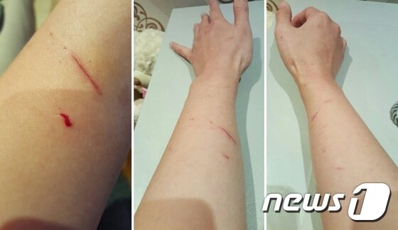 본문 이미지 - 도레 보호자의 팔엔 도레가 남긴 상처가 가득하다. ⓒ News1