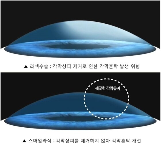 스마일라식, 라섹수술 부작용인 각막혼탁 어떻게 개선할까? - 뉴스1 스마일라식, 라섹수술 부작용인 각막혼탁 어떻게 개선할까? - 뉴스1