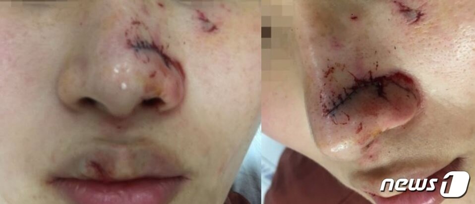 본문 이미지 - 시바견에 물린 모습.(사진 A씨 제공)ⓒ News1