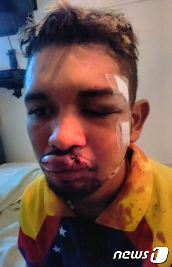 (카라카스 AFP=뉴스1) 우동명 기자 = 베네수엘라 반정부 시위현장에서 바이올린 연주를 해온 우일리 아르테아가가 23일(현지시간) 카라카스 야당 집회에서 얼굴에 크게 부상을 당한 …