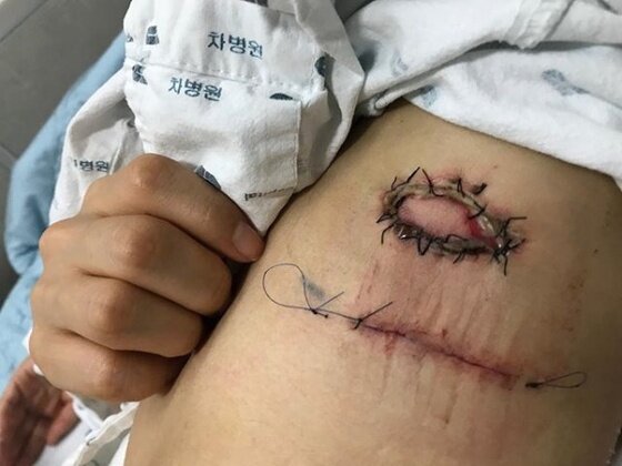 팔에 만져지는 부드러운 혹, 지방종 11