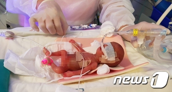 올 1월 체중 302g으로 태어나 서울아산병원 신생아집중치료실에서 치료를 받고 있는 사랑이(여자아이). 국내에서 생존한 초미숙아 중 가장 작게 태어났다.© News1