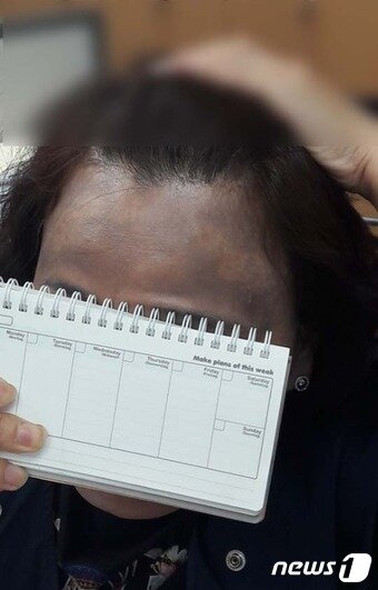 본문 이미지 - 헤나 방 시술 이후 피해자 모습ⓒ News1