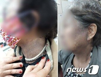 본문 이미지 - 헤나 방 시술 이후 피해자 모습들 ⓒ News1