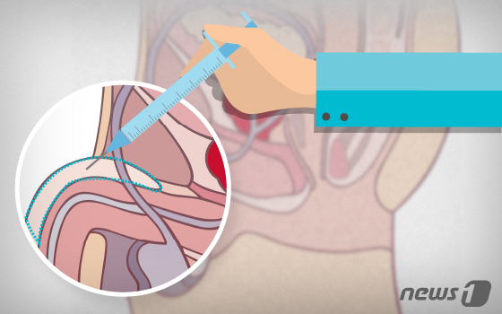 대전 비뇨기와 보형물의 단점을 보완한 확대 방법