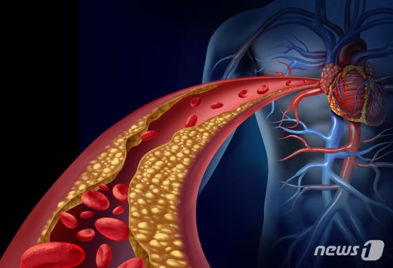 혈관 서서히 막히는 '이 병', 기온 '뚝' 겨울철이 위험한 이유