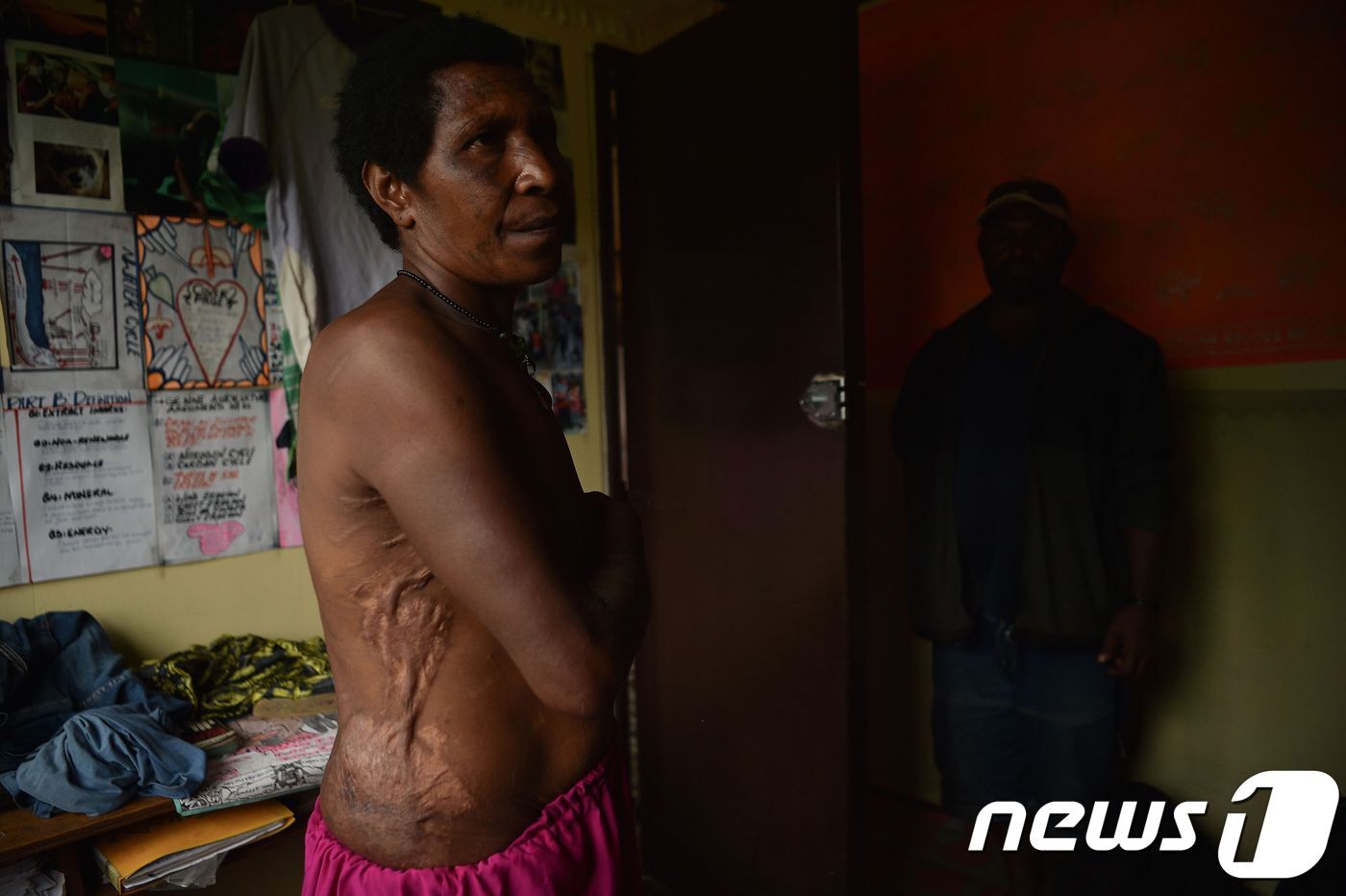 본문 이미지 - 파푸아뉴기니에서 마녀로 몰려 집단 폭행을 당한 55세 여성이 2018년 11월 자신의 상처를 보여주고 있다.  ⓒ AFP=뉴스1