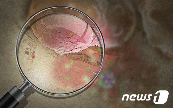 AZ 면역항암제 '임핀지' 위암 수술 전후 요법으로 유럽 진입 초읽기