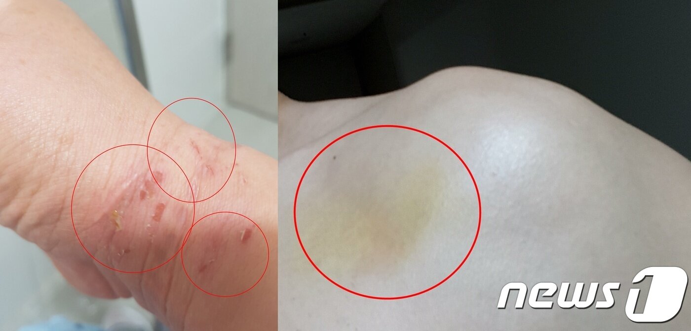 본문 이미지 - 지난 11월 16일 부산구치소에서 나온 A씨가 병원에서 치료를 받은 뒤 찍은 사진. 왼쪽 사진은 손목에 타박상을 입은 자국. 오른쪽 사진에서는 가슴 부위에 사퍼런 멍이 관찰된다. A씨는 병원에서 왼쪽 늑골 골절과 다발성 타박상 등 전치 4주 진단을 받았다. (A씨 제공)ⓒ 뉴스1