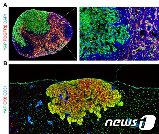 림프절에 전이된 흑색종(A)과 유방암(B) 모델 생쥐의 암세포를 형광염색법을 이용해 현미경으로 관찰한 결과 두 이미지 모두에서 YAP 전사인자(진한 녹색)가 활성화됨을 확인할 수 있다.(IBS 제공)© 뉴스1