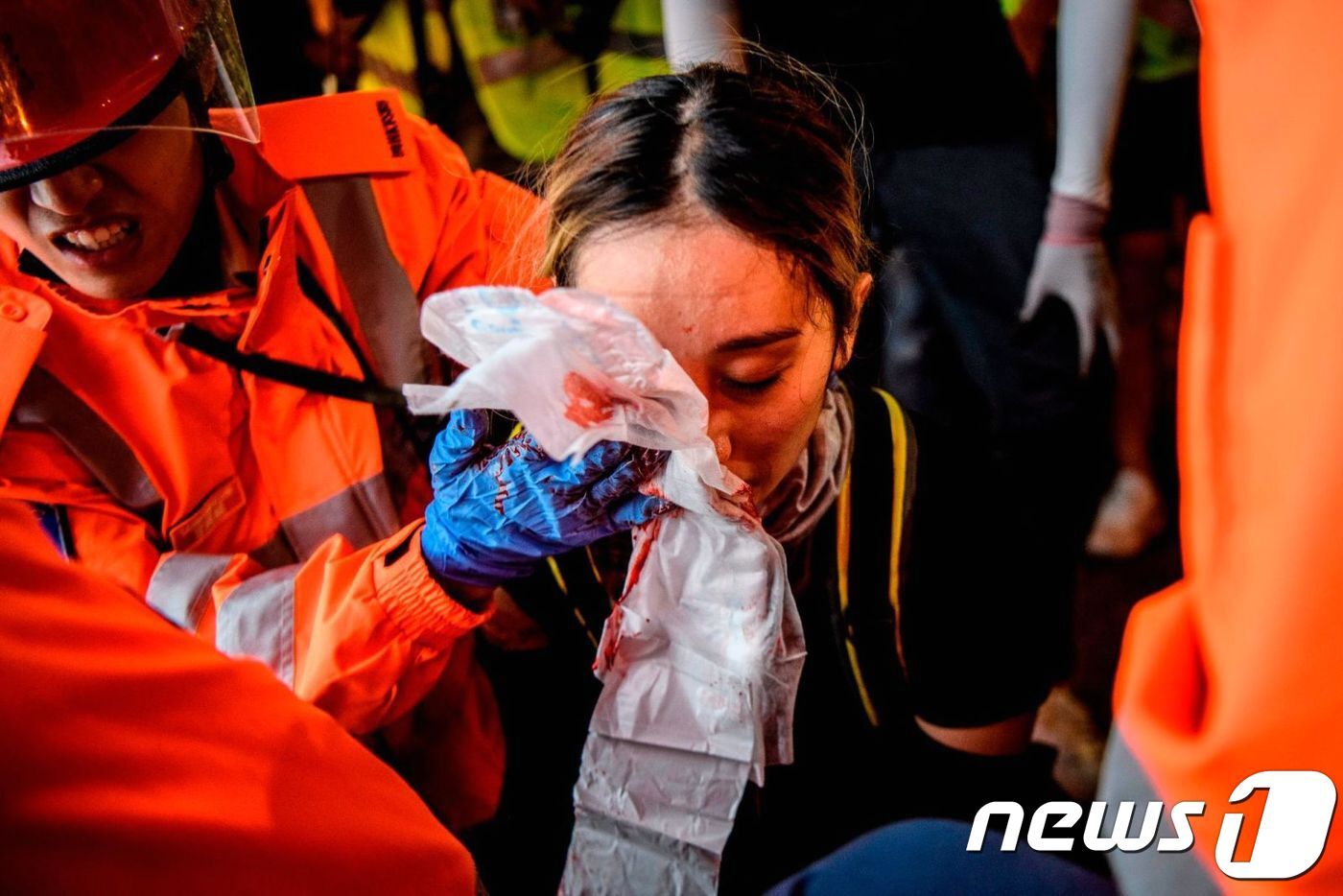 본문 이미지 - 11일 홍콩 침사추이에서 열린 집회 도중 경찰이 쏜 빈백건에 맞아 오른쪽 안구가 파열된 여성 시위 참가자. &#40;CNN&#41; ⓒ 뉴스1