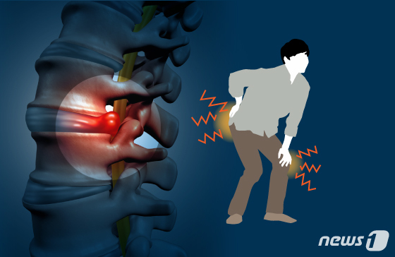 흡연이 허리 통증 부른다…척추 디스크 발생 위험 최대 1.42배