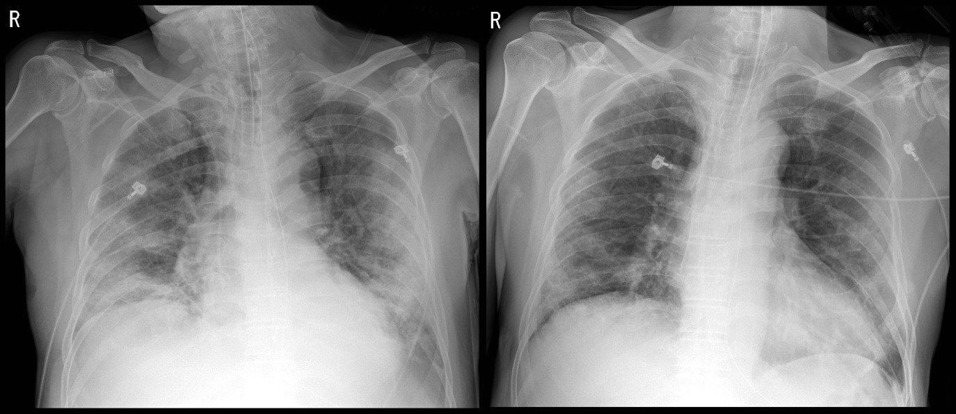 김모씨가 혈장치료를 받기 전&#40;좌&#41;과 후&#40;우&#41;의 흉부 X-ray 영상. 혈장치료 후 폐렴 등으로 뿌옇게 보이던 폐가 나아지고 있다.&#40;사진제공=세브란스병원&#41;ⓒ 뉴스1