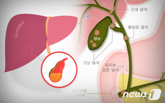 [100세건강] "살 빨리 빼려다 돌 생긴다"…담석증, 10년 새 2배