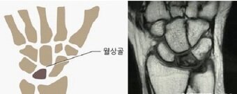 본문 이미지 - 키엔벡병 MRI ⓒ 뉴스1
