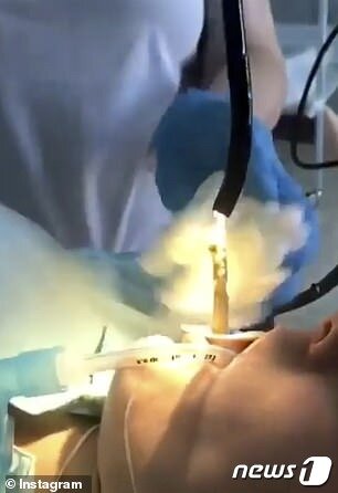 본문 이미지 - 의료진이 내시경을 이용해 여성의 입에서 알 수없는 물질을 끄집어 내고 있다. (인스타그램)ⓒ 뉴스1