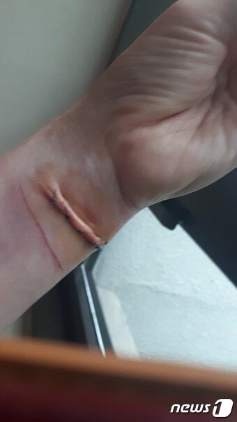 본문 이미지 - 김모 교수가 자해로 왼쪽 손목 인대  손상을 입어 긴급수술을 받았다. ⓒ 뉴스1