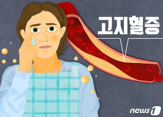 본문 이미지 - 불규칙한 생활 습관이나 운동 부족도 이상지질혈증을 유발할 수 있다. 스테로이드 제제 같은 약물이나 임신과 같은 신체 상태도 콜레스테롤 수치를 일시적으로 올릴 수 있다. 다양한 혈관 질환의 발생률과도 연관돼 관심을 기울여야 한다. ⓒ News1 DB