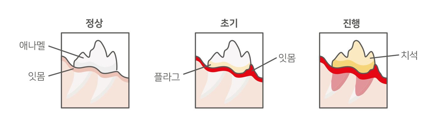본문 이미지 - 포메라니안 치주염 발생 단계. 사진 로얄캐닌 제공 ⓒ 뉴스1