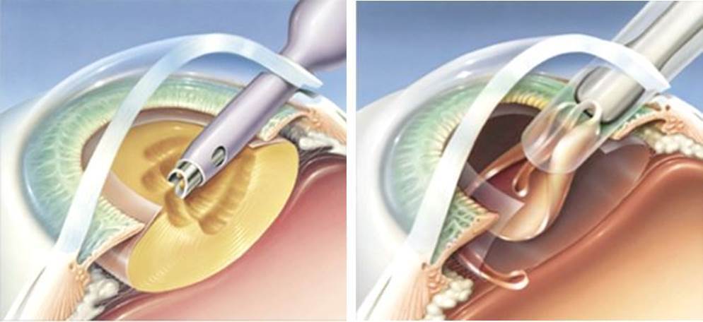 본문 이미지 - 초음파유화흡인술 및 인공렌즈 삽입술. 사진 vip동물의료센터 제공 ⓒ 뉴스1