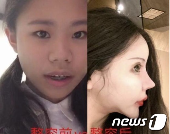 A Chinese woman who has undergone 100 plastic surgery from the age of 13…  “Sight and memory are weak”