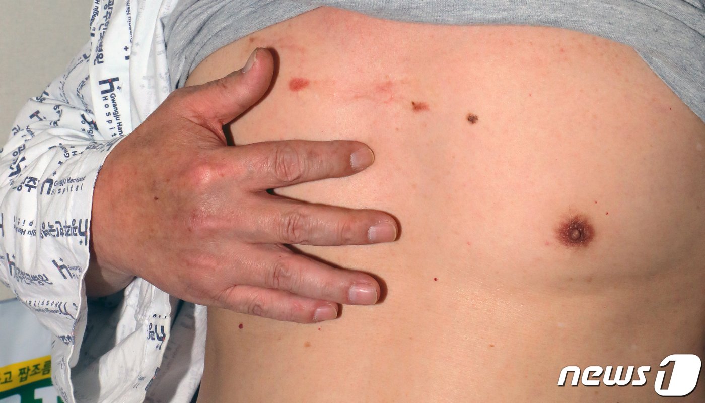 본문 이미지 - 7일 오후 광주 서구 한 종합병원 입원실에서 만난 홍창남씨(62)가 자신의 가슴에 난 상처를 보여주고 있다. 2022.1.8/뉴스1