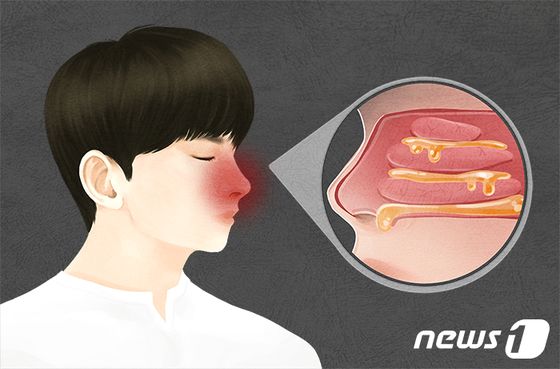 100세건강] 3달 넘게 누런코? 부비동염 만성 되면 두통·집중력 감소 - 뉴스1