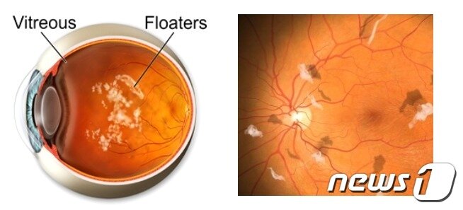 본문 이미지 - 비문증 모식도 (김안과병원 제공)