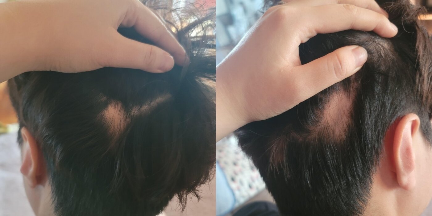 본문 이미지 - A씨의 두피 곳곳에 탈모가 진행되는 등 범위가 넓어지고 있다. (온라인 커뮤니티 갈무리) ⓒ 뉴스1