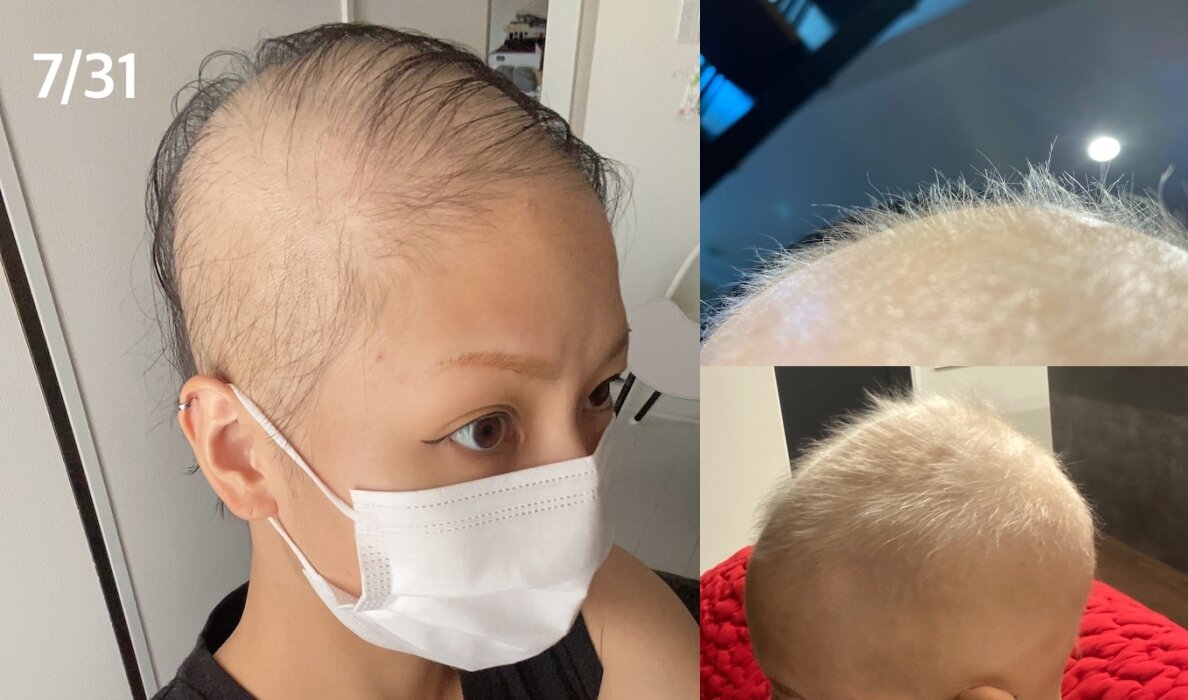 본문 이미지 - 모더나 접종 한 달 후 두피 상태(왼쪽), 스테로이드 펄스 치료를 받고 회복 중인 두피 모습(오른쪽). (블로그 갈무리) ⓒ 뉴스1