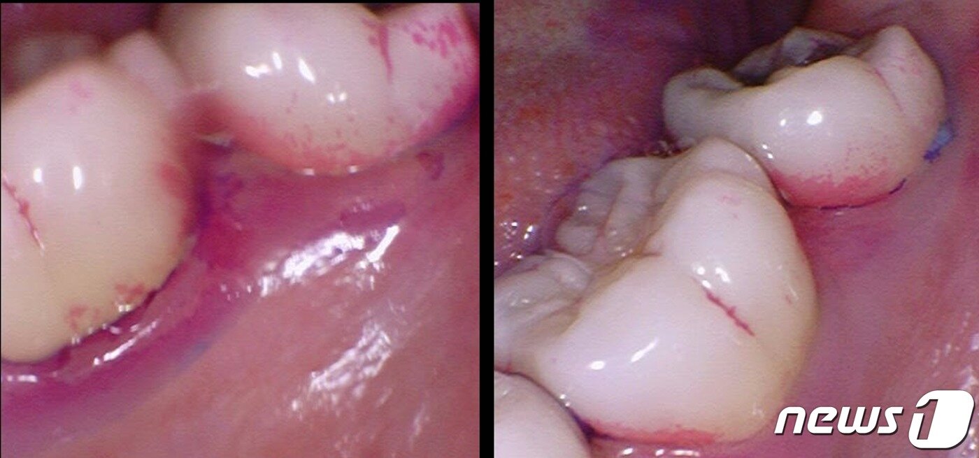본문 이미지 - 2월 3일 하악좌측 제1대구치 설면 모습(왼쪽)과 3월 4일 같은 치아의 치석 비교 모습. 보라색 치석염색제가 염색된 곳이 적어진 것을 확인할 수 있다. ⓒ 뉴스1 신윤하 기자