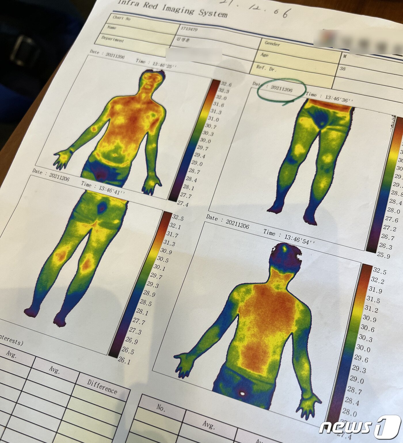 본문 이미지 - 상체는 37.9도 내외의 미열이 1년째 떨어지지 않고 있다. 김씨는 이에 대해 '타는듯한 고통이 끝나지 않았다'고 표현했다. 병원에서 측정한 김씨의 체열 사진은 상체에만 열이 몰려있었다.(김경훈씨 제공) ⓒ 뉴스1