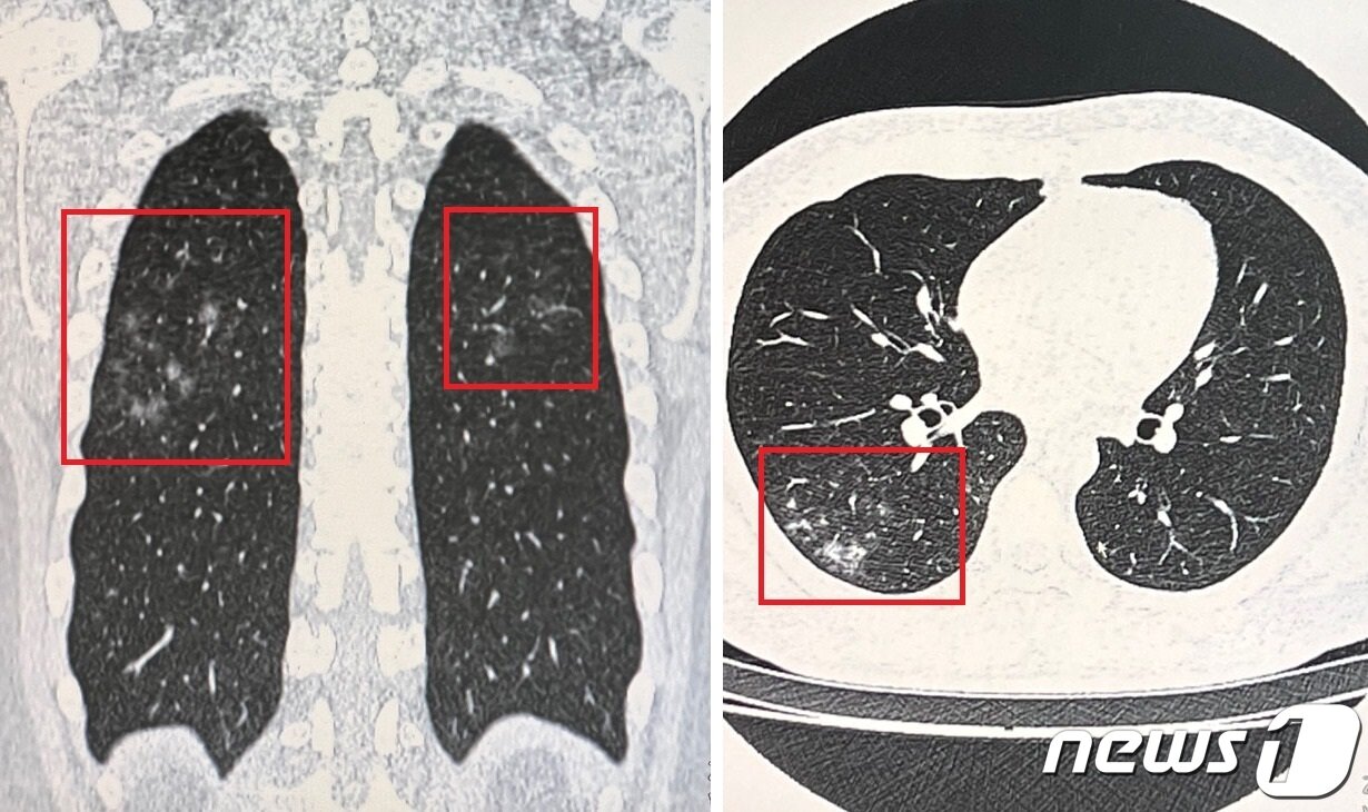 본문 이미지 - 코로나 후유증 클리닉에 폐렴 진단을 받았다. 폐의 세로 단면 CT 사진&#40;왼쪽&#41;과 가로 단면 CT 사진. 뿌옇게 번진 부분이 폐렴이 나타난 부위라는 설명을 받았다. 2022.04.14./뉴스1 ⓒ News1 김정현 기자