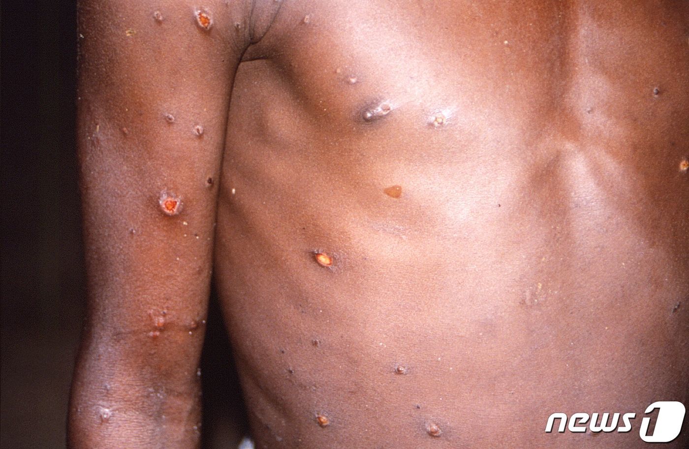 본문 이미지 - 미 질병통제예방센터&#40;CDC&#41;가 18일&#40;현지시간&#41; 공개한 원숭이두창 감염 증상 사진. ⓒ 로이터=뉴스1 ⓒ News1 원태성 기자