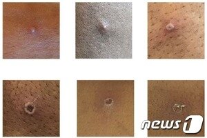 본문 이미지 - 영국 보건안전청이 제공한 원숭이 두창 환자의 피부 발진 사진. ⓒ 뉴스1 (영국 보건안전청, UKHSA)