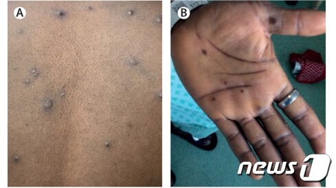 본문 이미지 - 원숭이두창 (The Lancet Infectious Disease 사진을 서울대학교병원에서 제공) ⓒ 뉴스1