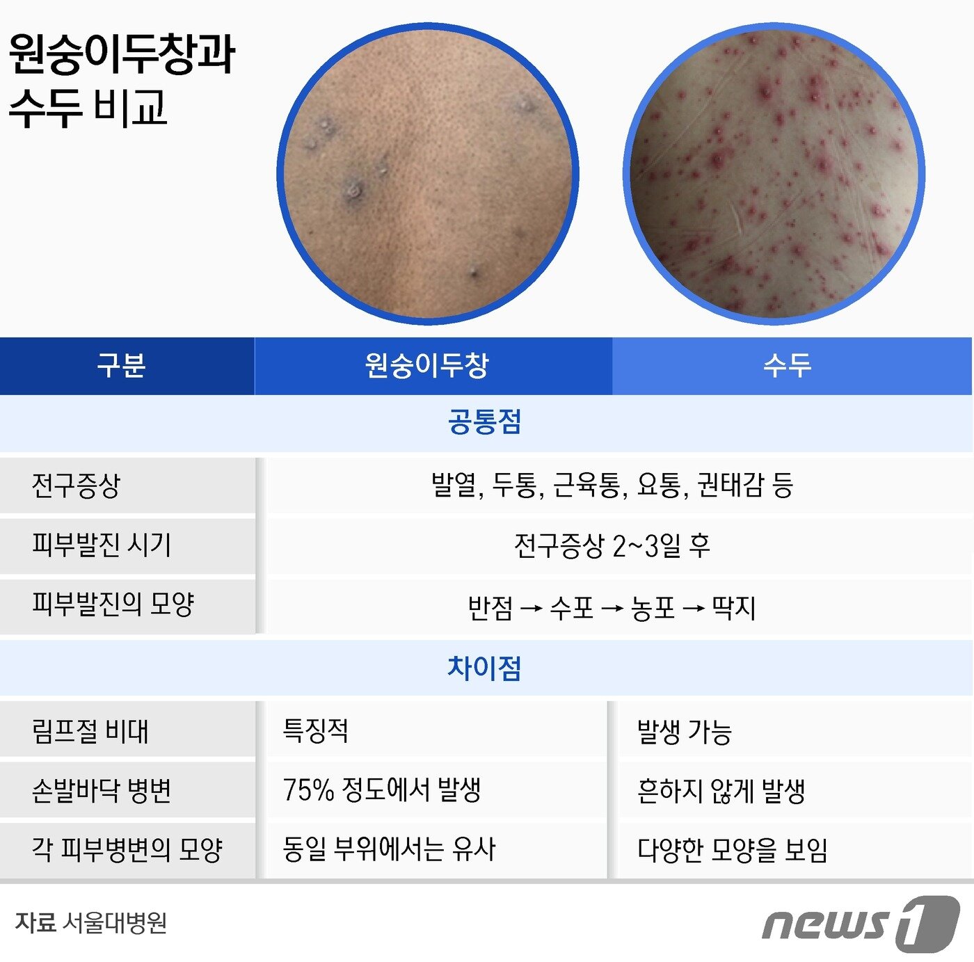 본문 이미지 - 원숭이두창과 수두 간 비교 ⓒ News1 윤주희 디자이너