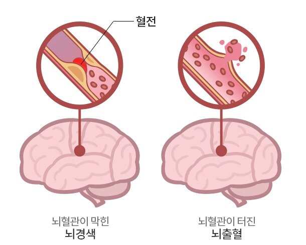 본문 이미지 - (분당서울대병원 제공) ⓒ 뉴스1