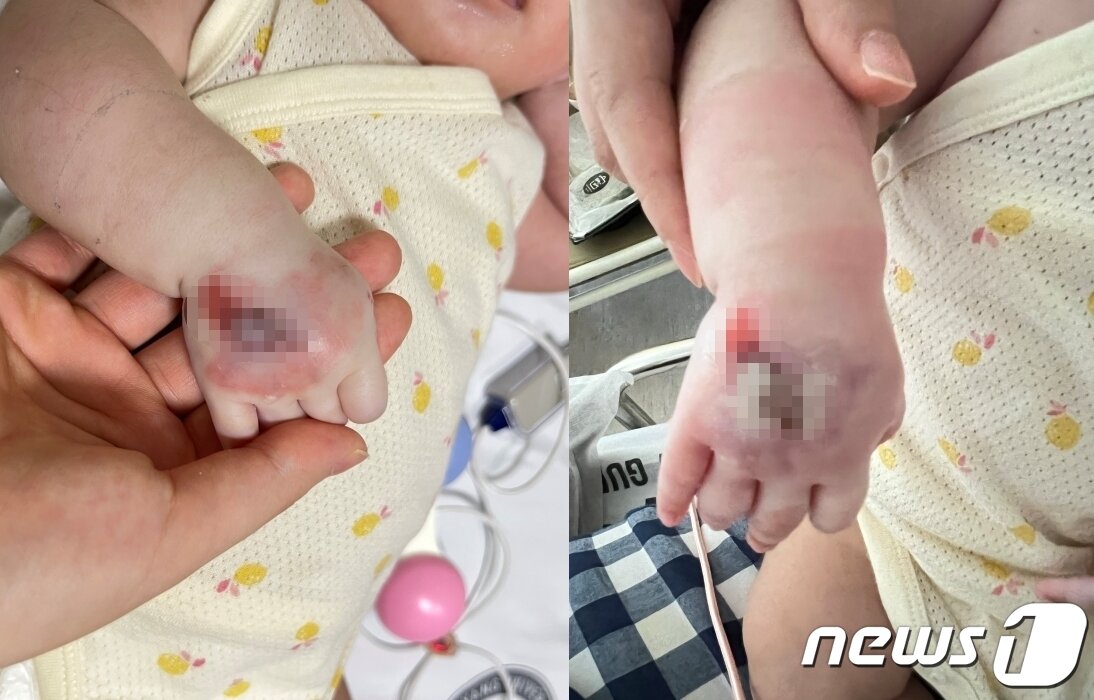 본문 이미지 - 연고 바른 후 거즈 덧대고 있다가 잠시 풀었을 때(왼쪽), 성형외과에서 거즈 푸르고 확인했을 때(오른쪽). (온라인 커뮤니티 갈무리) ⓒ 뉴스1