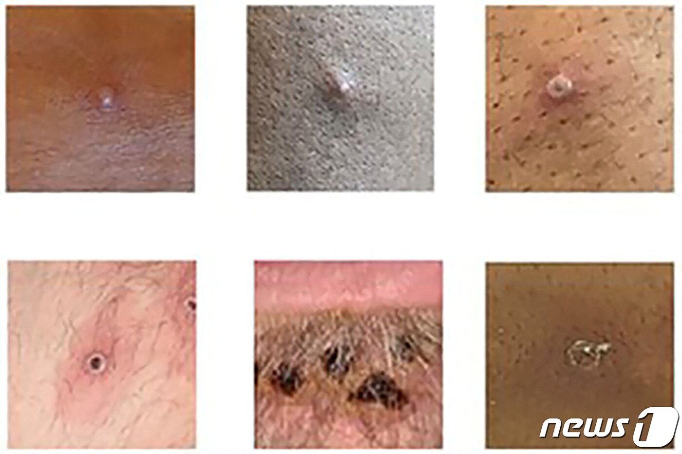 본문 이미지 - 영국 보건안전청(UKHSA)이 공개한 원숭이두창 감염에 따른 피부병변·발진 사례2022.06.22 ⓒ AFP=뉴스1 ⓒ News1 정윤미 기자
